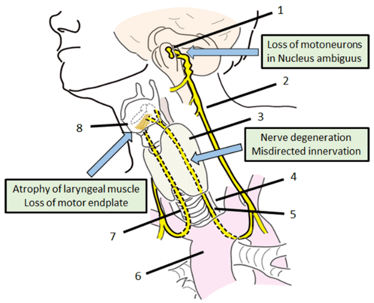 In icd-10-pcs percutaneous radiofrequency ablation of the left vocal cord